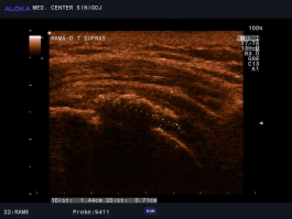 Ultrazvok rame - kalcinacija ob narastišču tetive supraspinatusa na veliki tuberkel - ESWT indikacija